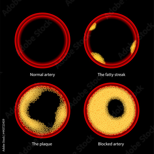 Cholesterol and atherosclerosis