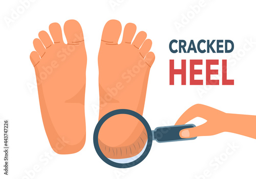 Hand holding magnifying glass with cracked heel in flat design on white background. Close up on dry black cracked heel skin.