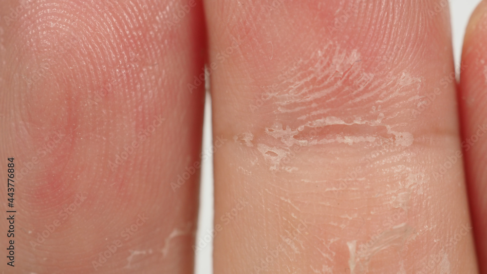 Skin peeling on hand and finger isolated on white background.Isolated Skin peeling on hand and finger isolated on white background.Isolated