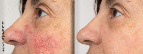 A close-up portrait of before and after a mature woman showing redness on her cheeks. The concept of rosacea photo