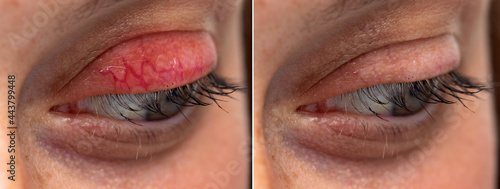 Human eye upper eyelid chalazion before and after side by side blepharitis comparison photo