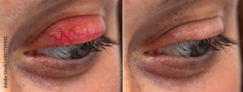 Human eye upper eyelid chalazion before and after side by side blepharitis comparison
