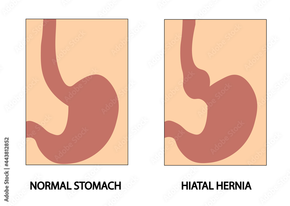 Hiatus hernia. Hiatal hernia. Types of hiatal hernia illustration Stock