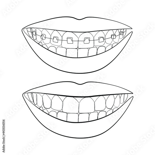 Teeth with braces, female smile line art on white isolated background