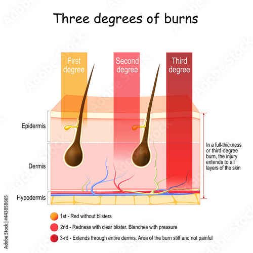 skin burn. Three degrees of burns. type of injury to skin