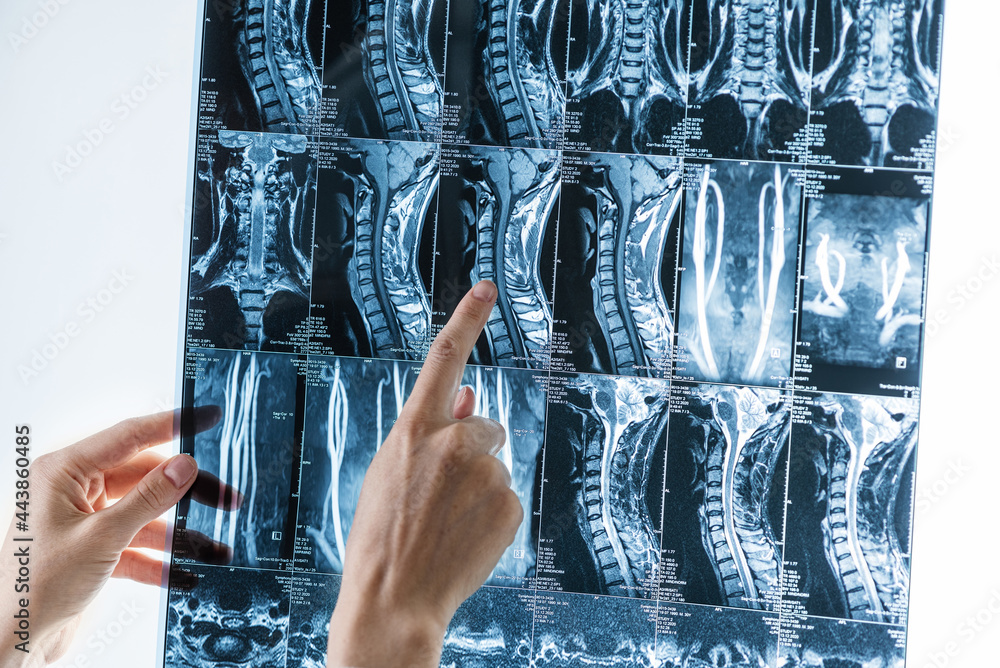 Φωτογραφία series of mri images of cervical spine in hands of specialist, osteochondrosis,