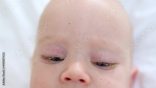 portrait of baby infant with conjunctivitis pink eye in newborn close-up view. healthcare medicine neonatal problems concept photo