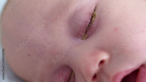 portrait of sleeping baby infant with conjunctivitis pink eye crusts in newborn close-up view. healthcare medicine neonatal problems concept photo