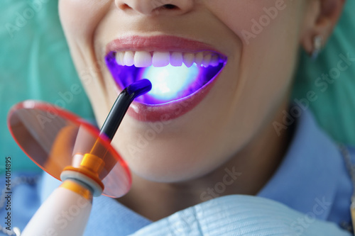 фотографія Dentist doctor fills patient teeth with curing light closeup