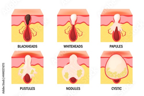 Acne types set. Skin disease, dermatology, cosmetology concept.