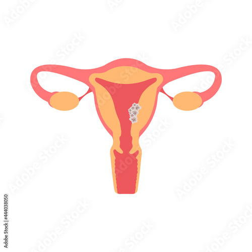 Uterus cancer flat illustration. Fertility, human anatomy, female reproductive system. Disease, gynecology, oncology.
Tumor cells on endometrium tissue of uterus
