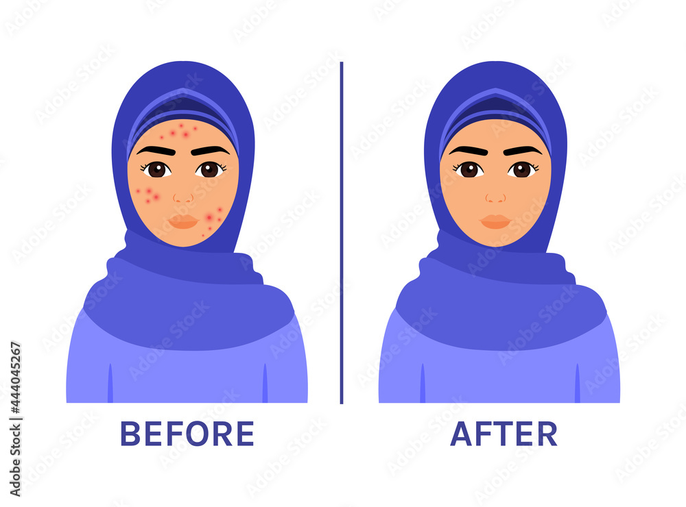 Arab Woman In Hijab With Pimples On Face Problem Skin Of A Muslim Girl arab-woman-in-hijab-with-pimples-on-face-problem-skin-of-a-muslim-girl