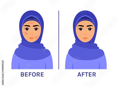 Arab Woman in Hijab with Pimples on Face. Problem Skin of a Muslim Girl. Acne treatment. Before After. Healthy Hygiene. Flat cartoon color style. Illustration for Beauty Medical design. Vector.