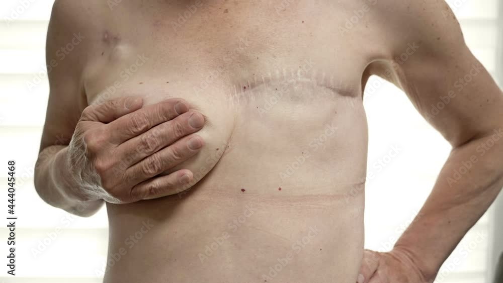 Preparing for breast reconstruction for a woman undergoing mastectomy. Breast plastic surgery after mastectomy. Preparing for breast reconstruction for a woman undergoing mastectomy. Breast plastic surgery after mastectomy.