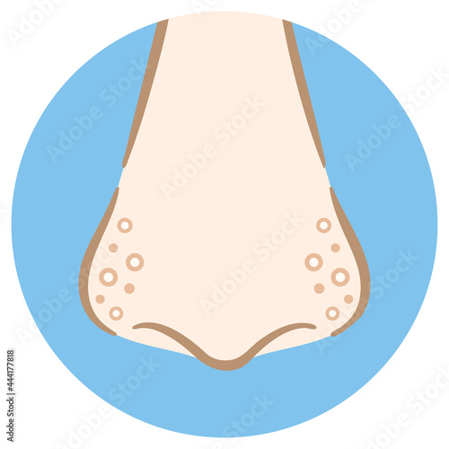 小鼻の毛穴が白い角栓で汚れているイラスト　おしゃれな手描き風