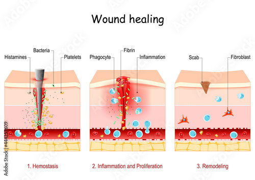 wound healing. Stages of the post-trauma repairing process