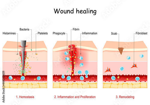 wound healing. Stages of the post-trauma repairing process