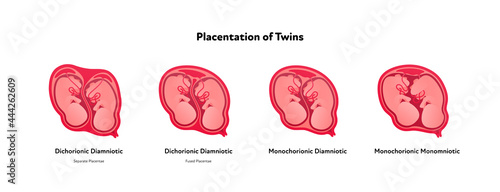 Embryo in womb medical diagram. Vector flat healthcare illustration. Placentation of twins in uterus during position. Design for health care, education.