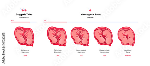Embryo in womb medical diagram. Vector flat healthcare illustration. Placentation of twins in uterus during position. Monozygotic and dizygotic baby. Design for health care, education. photo