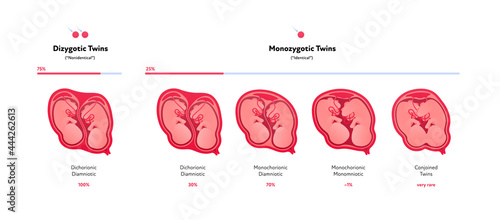 Embryo in womb medical diagram. Vector flat healthcare illustration. Placentation of twins in uterus during position. Monozygotic and dizygotic baby. Design for health care, education.