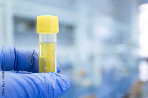 The scientist holds in his hand a test tube with a yellow experimental liquid from diseases, the close-up.