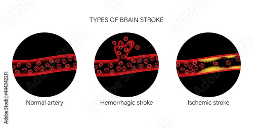 Brain stroke ishemic and hemorrhagic