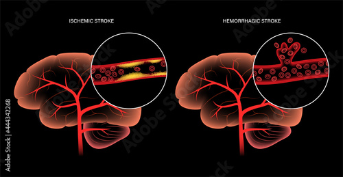 Brain stroke ishemic and hemorrhagic