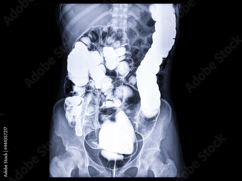 Φωτογραφία Barium enema or BE is image of large bowel after injection of barium contrast fi