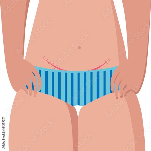Part of the female body with a scar on the abdomen on a white background
