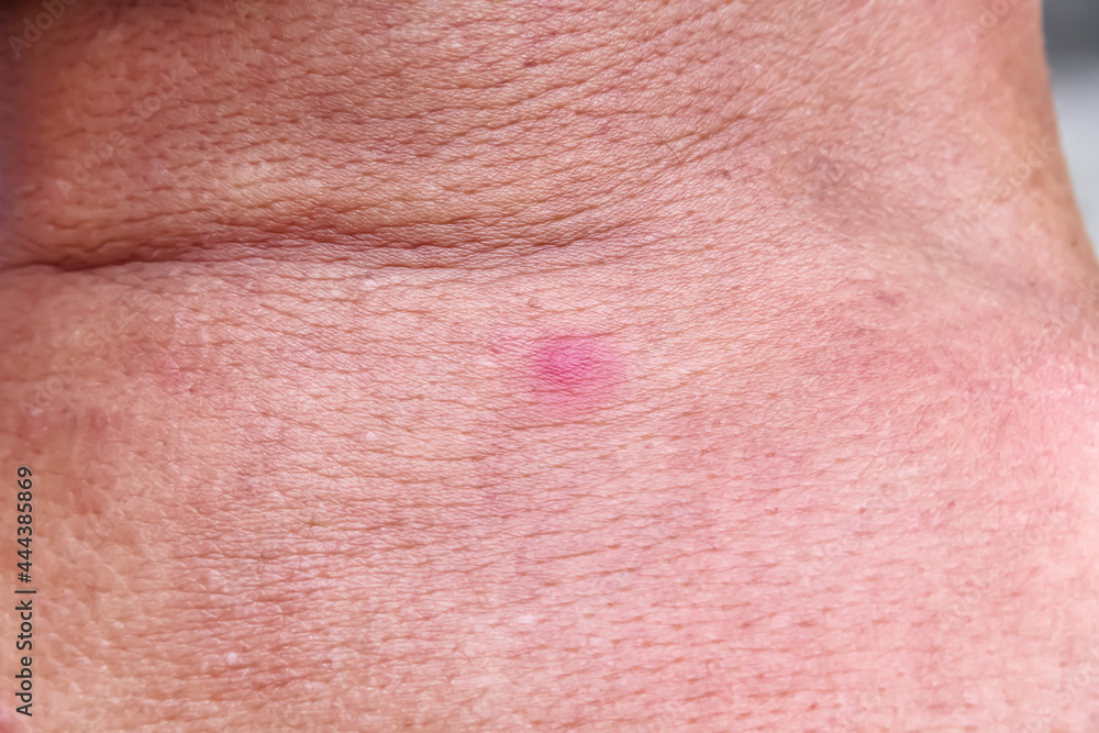 Red rash skin background on back of asian old man neck Red rash skin background on back of asian old man neck
