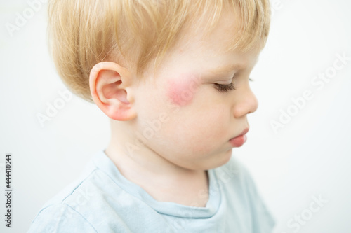 portrait of little Boy with allergic red spot at face cause by mosquito bite photo