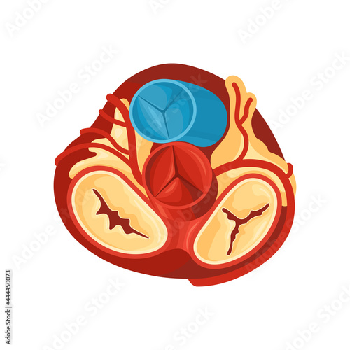 Diseased Heart Anatomy