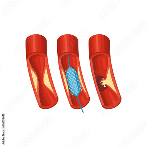 Aorta Diseases Illustration