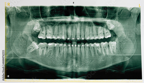 Dental x-ray photo of teenager skull and teeth with braces. Orthodontic treatment for healthy teeth. Tooth straightening health care