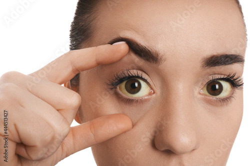 Woman checking her health condition on white background  closeup. Yellow eyes as symptom of problems with liver