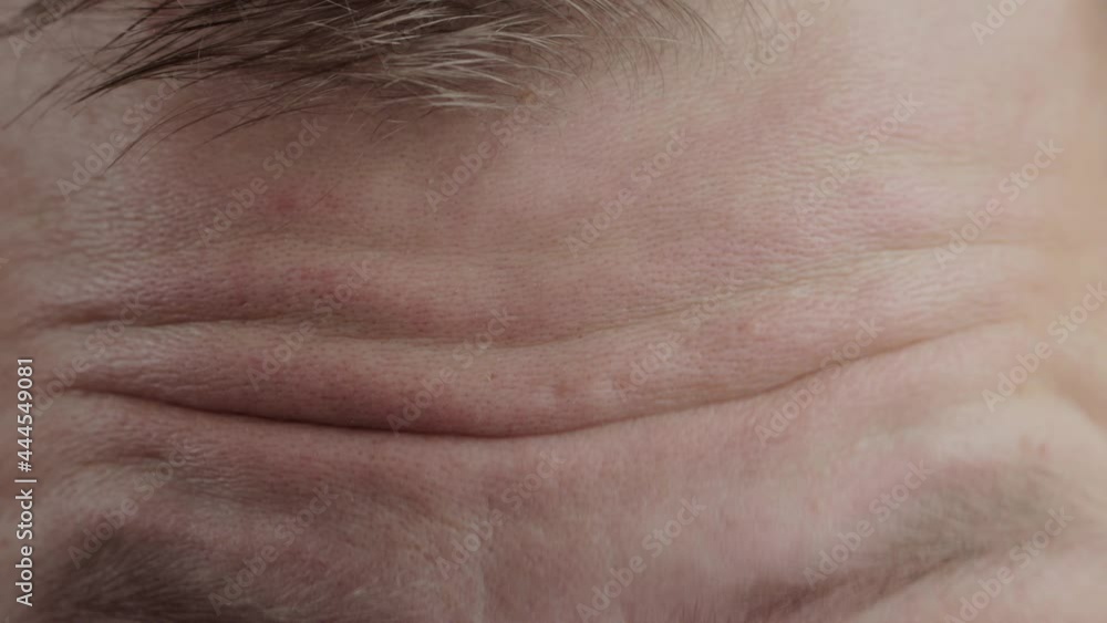 Wrinkles on a man's forehead, close-up. Facial expression. Wrinkle treatment Wrinkles on a man's forehead, close-up. Facial expression. Wrinkle treatment