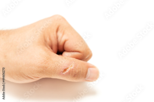 Slika na platnu Male hand with a deep healing cut on the finger isolated on white background