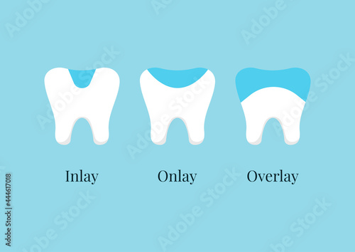 Tooth dental ceramic inlay, onlay, overlay or crown treatment set. Teeth dentistry restoration with porcelain sealant in cavity. Vector flat design cartoon style clip art illustration. photo