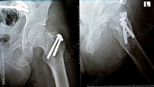 Selective focus of a plain x ray on left hip joined with a fracture of the greater trochanter of femur fixed with 2 screws in an open reduction surgery and a fracture of symphysis pubis after accident photo