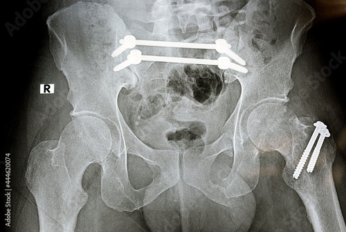 Fotografie selective focus Plain x ray with a fracture pelvis that is fixed with 4 screws a