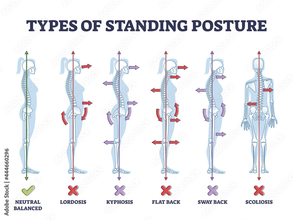 © VectorMine - Types of standing postures and medical back pathology set outline diagram. Educational labeled collection with spine curvature problems compared to healthy neutral balanced example vector illustration © VectorMine - Types of standing postures and medical back pathology set outline diagram. Educational labeled collection with spine curvature problems compared to healthy neutral balanced example vector illustration