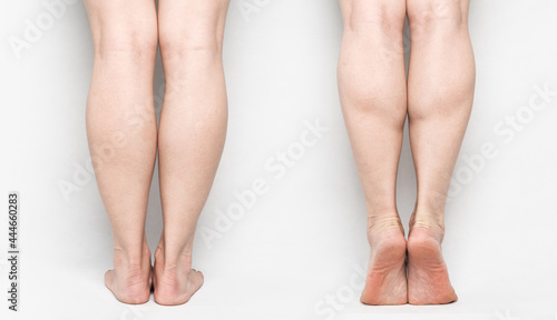 comparison of back view of muscular calf in standing and tiptoeing  