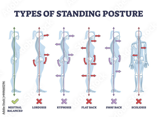 Types of standing postures and medical back pathology set outline diagram. Educational labeled collection with spine curvature problems compared to healthy neutral balanced example vector illustration photo