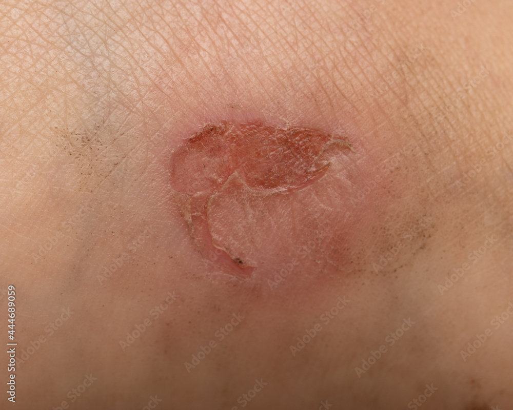 Fototapeta premium leg injury from uncomfortable shoes