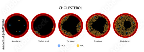 Cholesterol blood artery