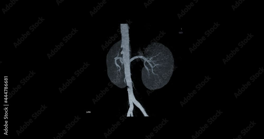 Stockvideo CTA Abdominal or CTA renal adtery 3D MIP image rotating on ...