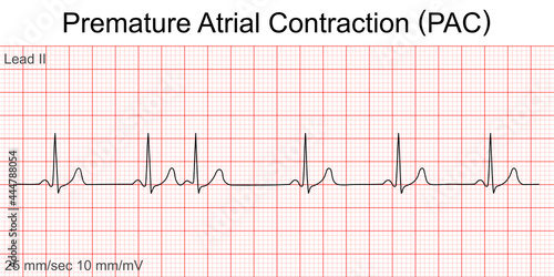 Electrocardiogram show Premature Atrial Contraction (PAC) pattern ,Heart beat ,ECG ,EKG interpretation ,Vital sign ,Life line ,Medical healthcare symbol. photo