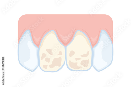 Dentistry: Damaged enamel of the front teeth. Dental problems. Vector illustration for teaching materials on dentistry.