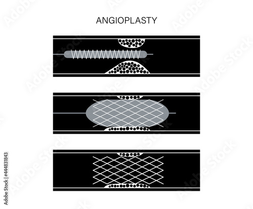 Angioplasty cardiac stent