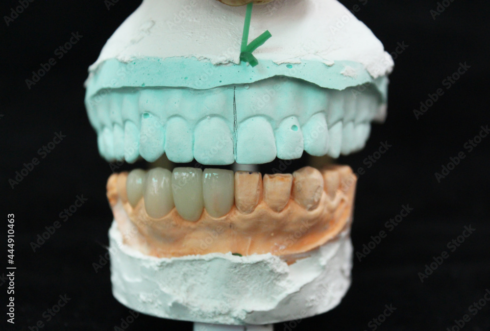 Dental crowns and veneers in the plaster model Dental crowns and veneers in the plaster model